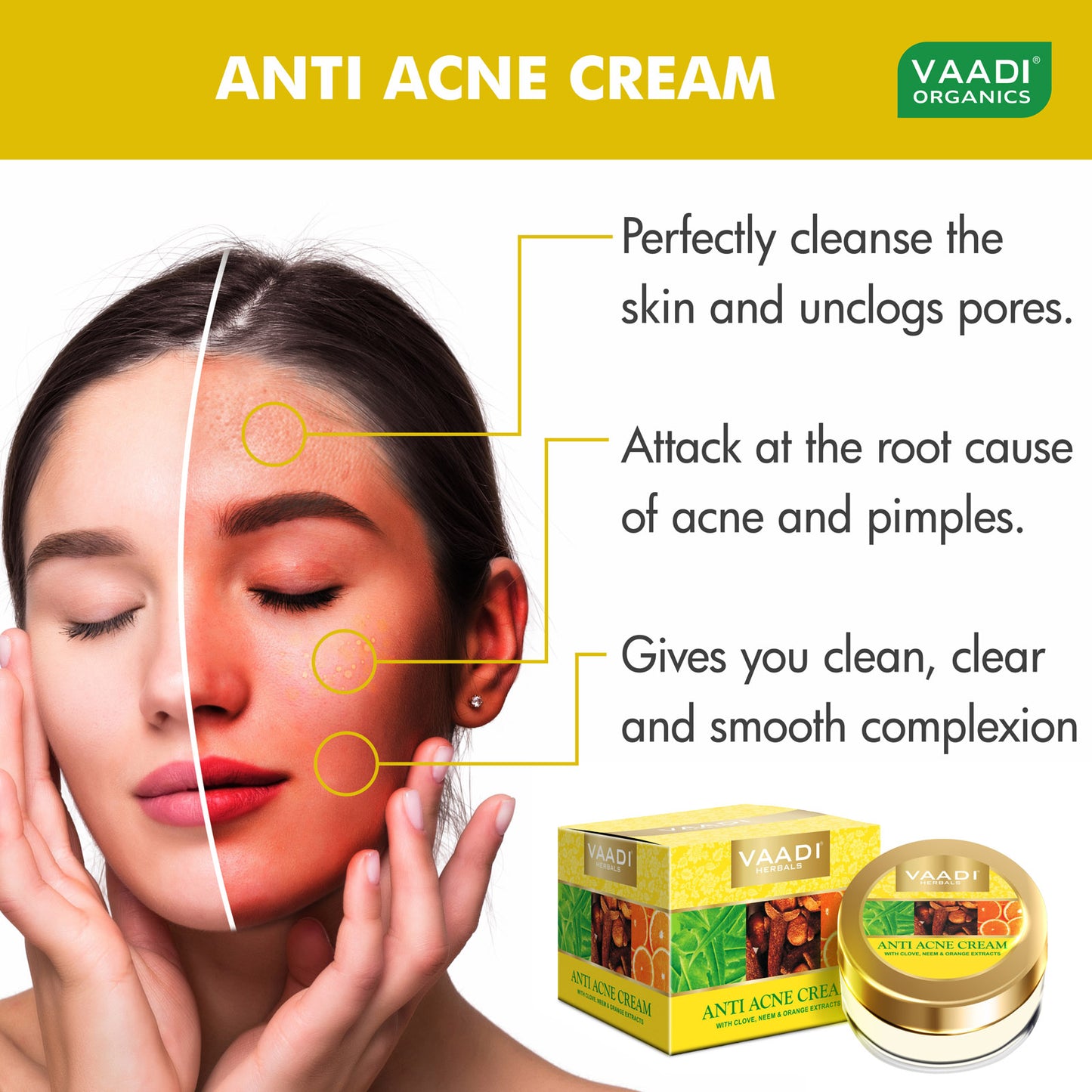 Anti Acne Cream with Clove Oil & Neem Extract - Anti Bacterial Therapy Controls Excess Oil Prevents Acne (30 gms / 1.1 oz)